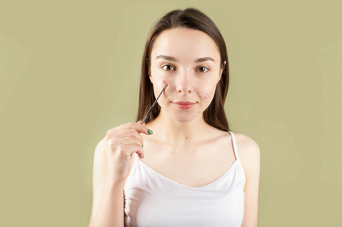Best Skincare Tips for Acne-Prone Skin